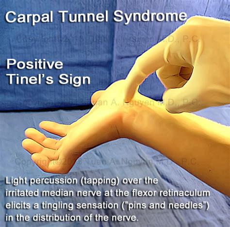 tinel sign carpal tunnel syndrome